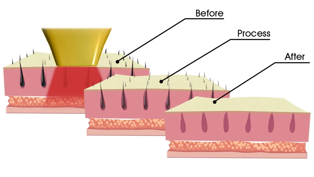 diode laser hair removal