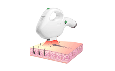 The Revolutionary Benefits of Super Hair Removal Machines for Skin Rejuvenation